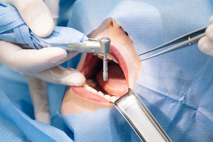 Why People Prefer Dental Implants over Traditional Dentures?