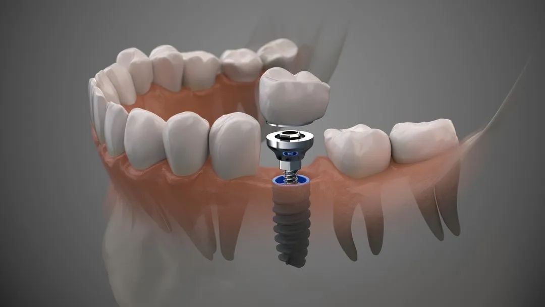 Dental Implants: A Comprehensive Guide to Restoring Your Smile and Oral Health